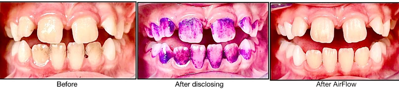 Before and after photos with dental procedures