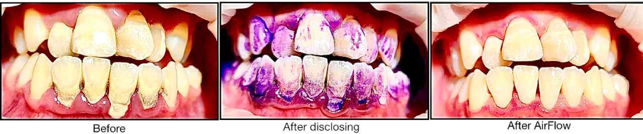 Before and after photos with dental procedures