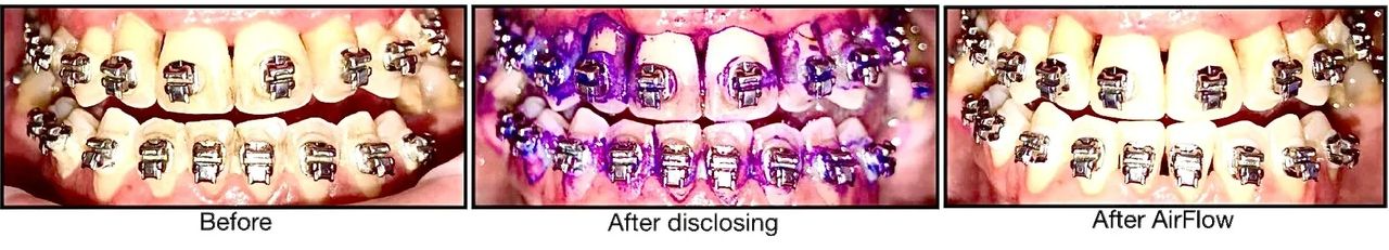 Before and after photos with dental procedures